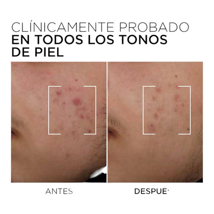 L’Oréal Paris Men Expert Derma Control Sérum Anti-Imperfecciones 30 ml, con 3% Niacinamida y Ácido Salicílico, para Piel Grasa con Tendencia Acnéica