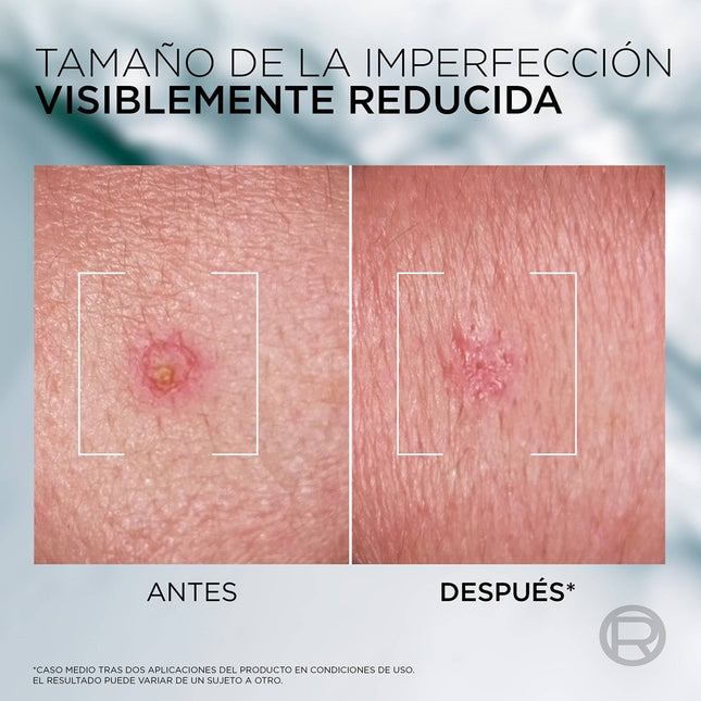 L’Oréal Men Expert Derma Control S.O.S Pimple Paste, Tratamiento Local para Imperfecciones con 5% Niacinamida y Ácido Glicólico, Cuidado Facial para Hombre